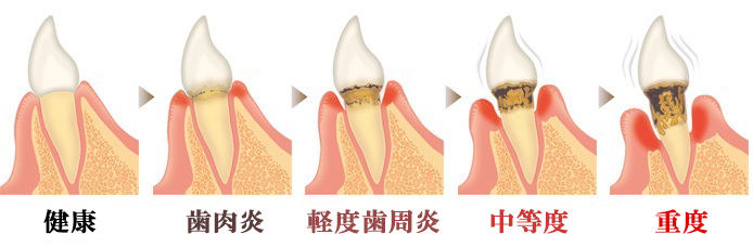 歯周病の進行